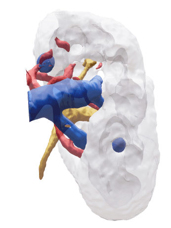 Rappresentazione 3D di un intervento di chirurgia renale